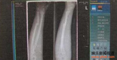 “碰瓷党”拐买13岁少年 打断手臂送异地诈钱